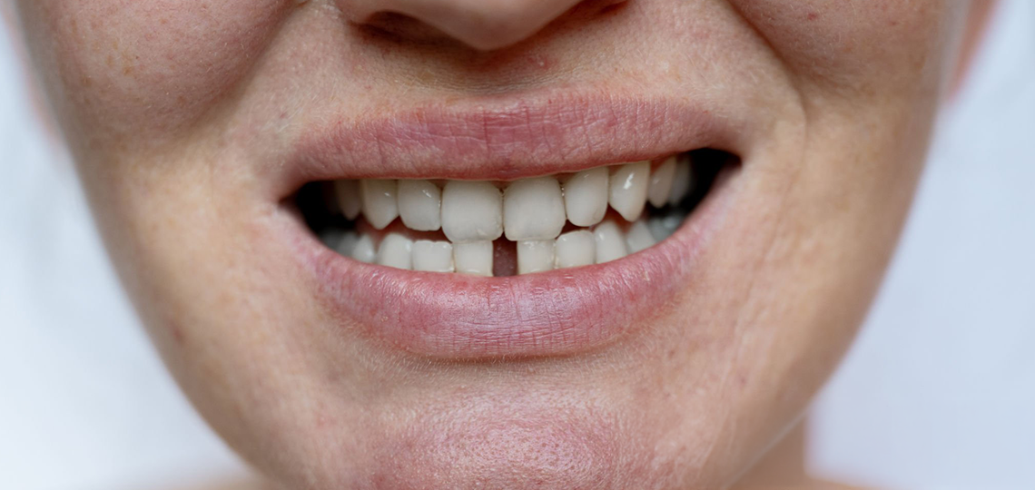 Espaço entre os dentes (diastema): Opções para fechar ou manter.