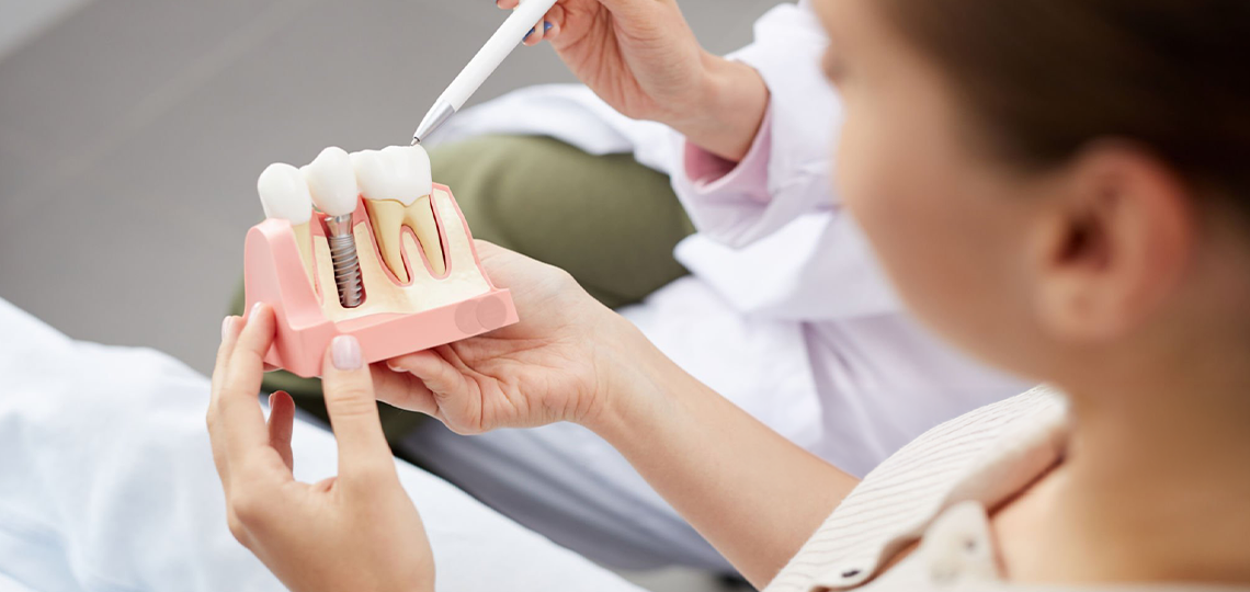 Implante de carga imediata: É possível sair com dentes no mesmo dia?