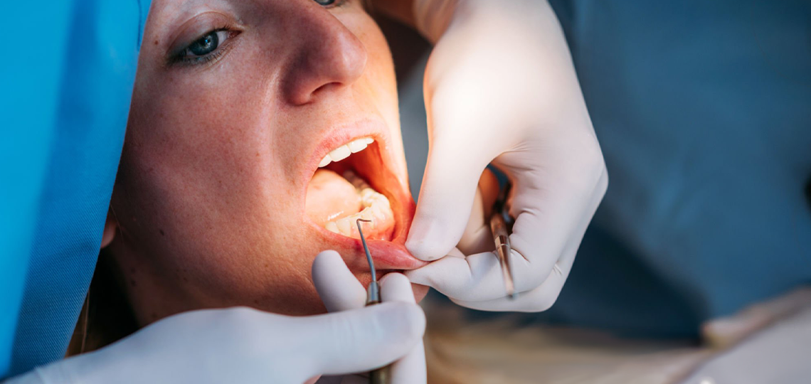 O que é placa bacteriana e como ela destrói o esmalte dental.